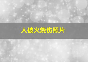 人被火烧伤照片