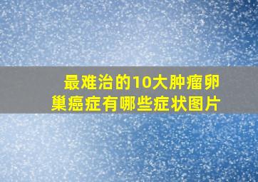 最难治的10大肿瘤卵巢癌症有哪些症状图片