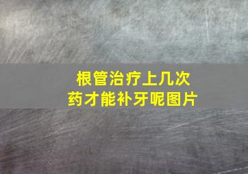 根管治疗上几次药才能补牙呢图片