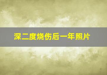 深二度烧伤后一年照片