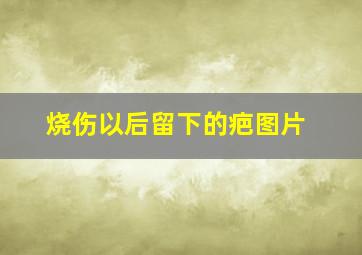 烧伤以后留下的疤图片