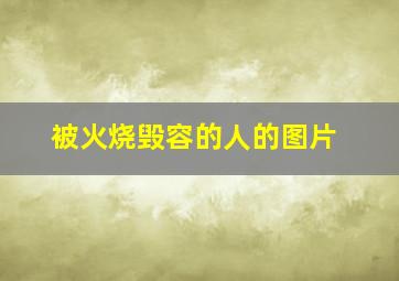 被火烧毁容的人的图片