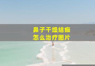 鼻子干燥结痂怎么治疗图片