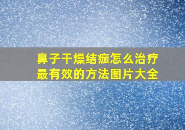 鼻子干燥结痂怎么治疗最有效的方法图片大全