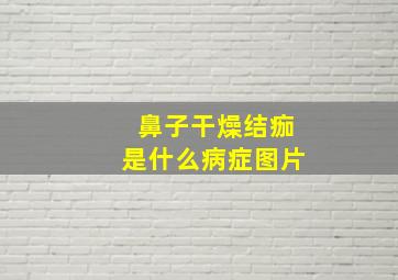 鼻子干燥结痂是什么病症图片