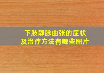 下肢静脉曲张的症状及治疗方法有哪些图片