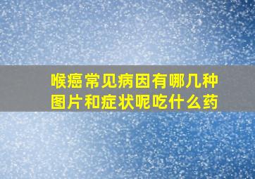 喉癌常见病因有哪几种图片和症状呢吃什么药