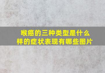 喉癌的三种类型是什么样的症状表现有哪些图片