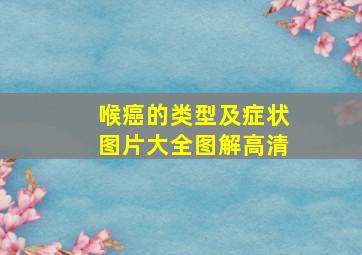 喉癌的类型及症状图片大全图解高清