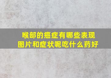 喉部的癌症有哪些表现图片和症状呢吃什么药好