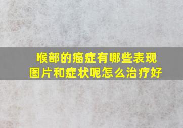 喉部的癌症有哪些表现图片和症状呢怎么治疗好