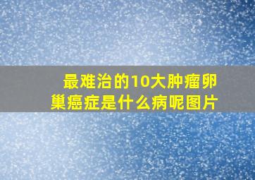 最难治的10大肿瘤卵巢癌症是什么病呢图片