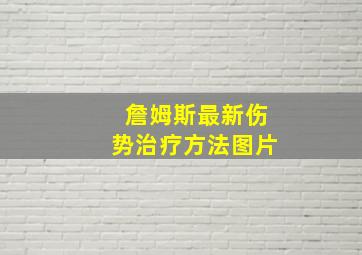 詹姆斯最新伤势治疗方法图片