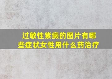 过敏性紫癜的图片有哪些症状女性用什么药治疗